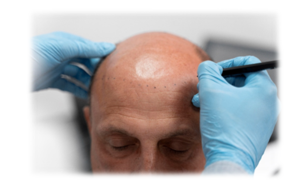 How long hair transplant last in the UK