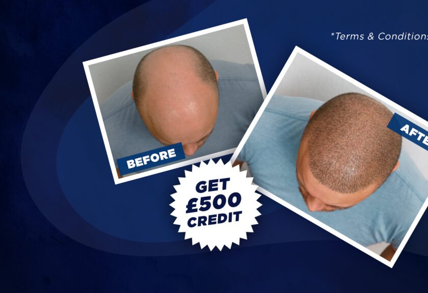 FUE Hair Restoration Offer