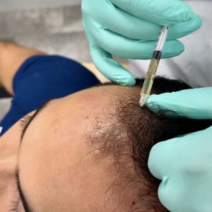 Royal PRP Treatment - 3 Sessions (Microneedling + PRP)