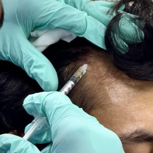 PRP Treatment (6 Sessions)
