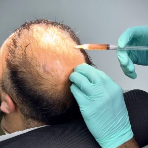 PRP Treatment (3 Sessions)