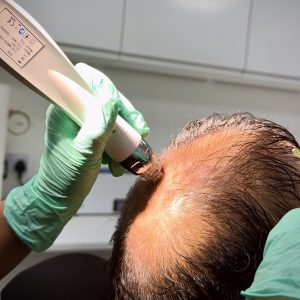 Royal PRP Treatment - 6 Sessions (Microneedling + PRP)