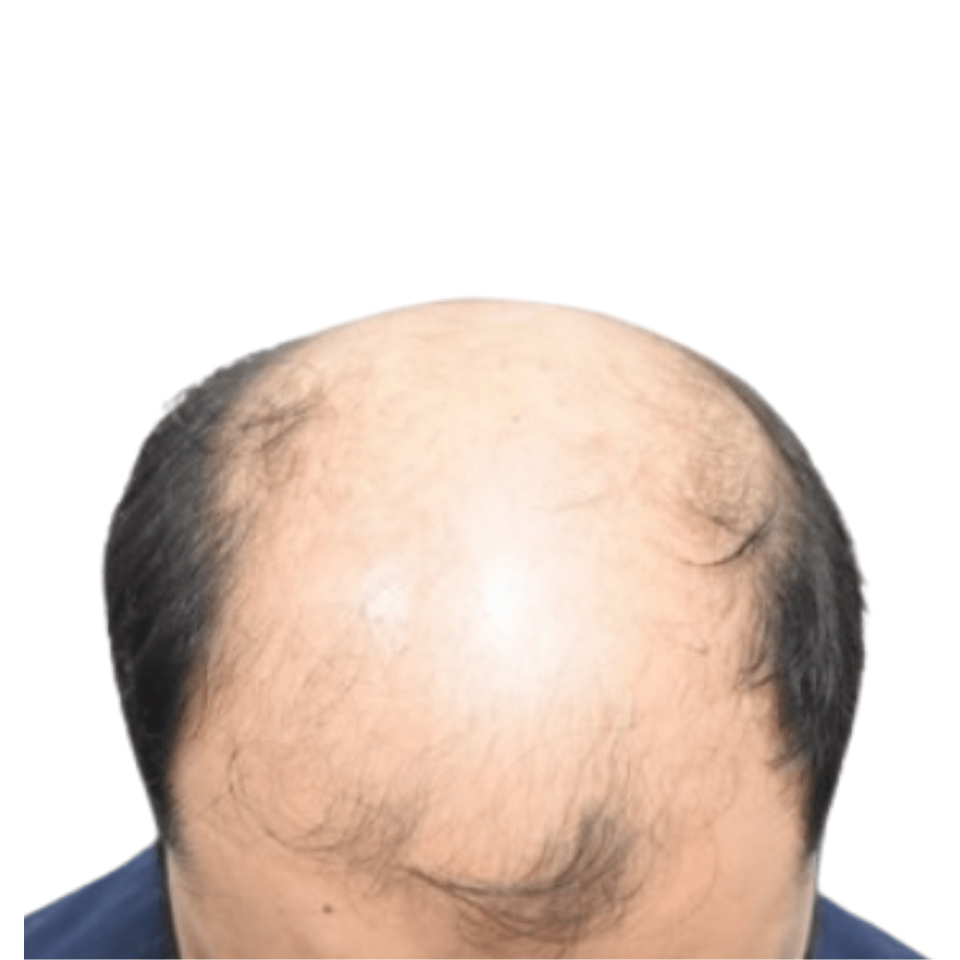 Before-Patient-15-v3