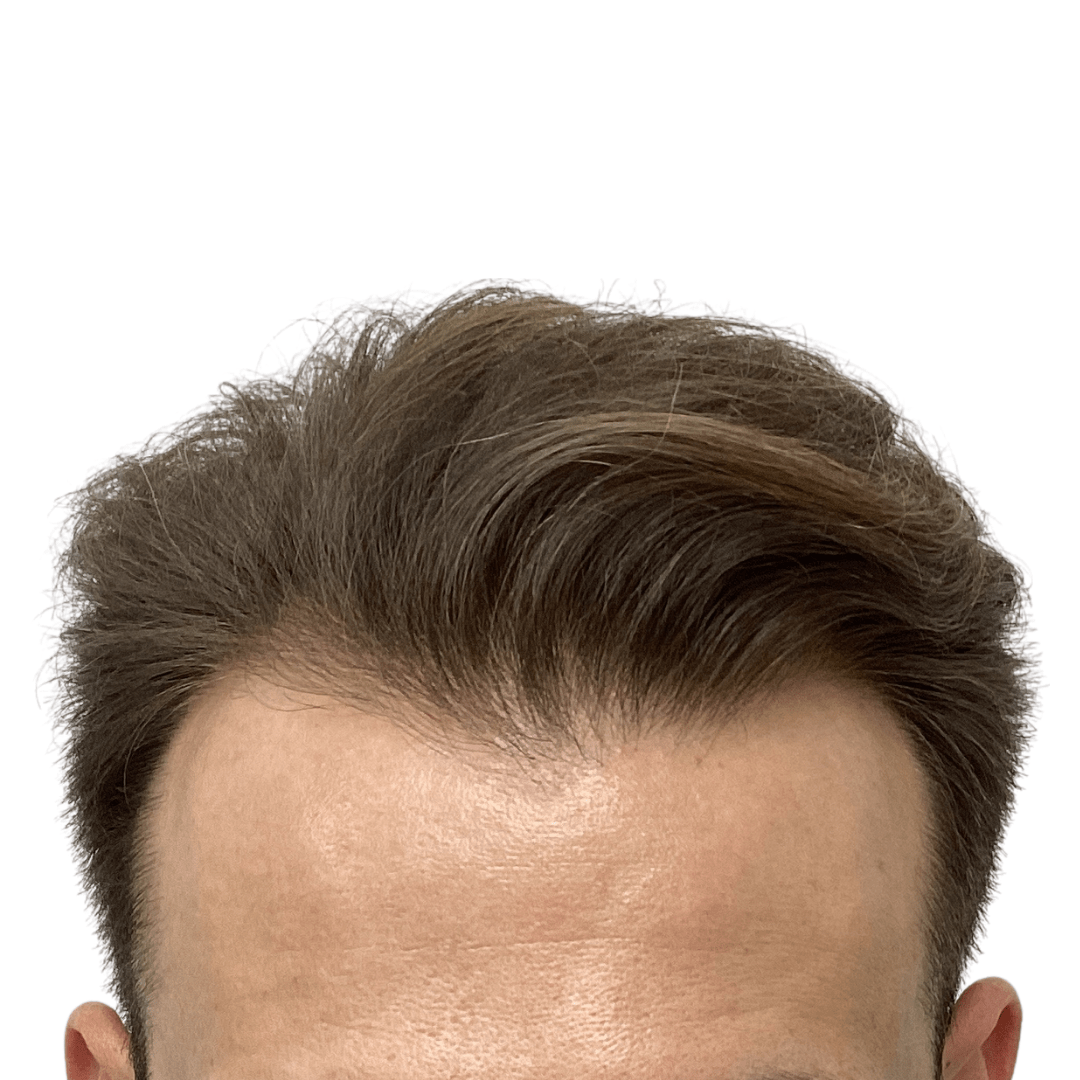 Before-Patient-5-v2