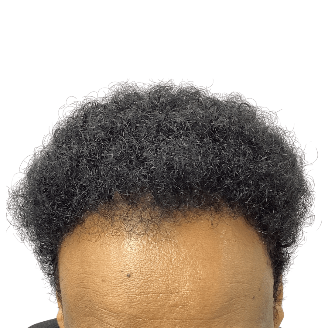 Before-Patient-8-v2