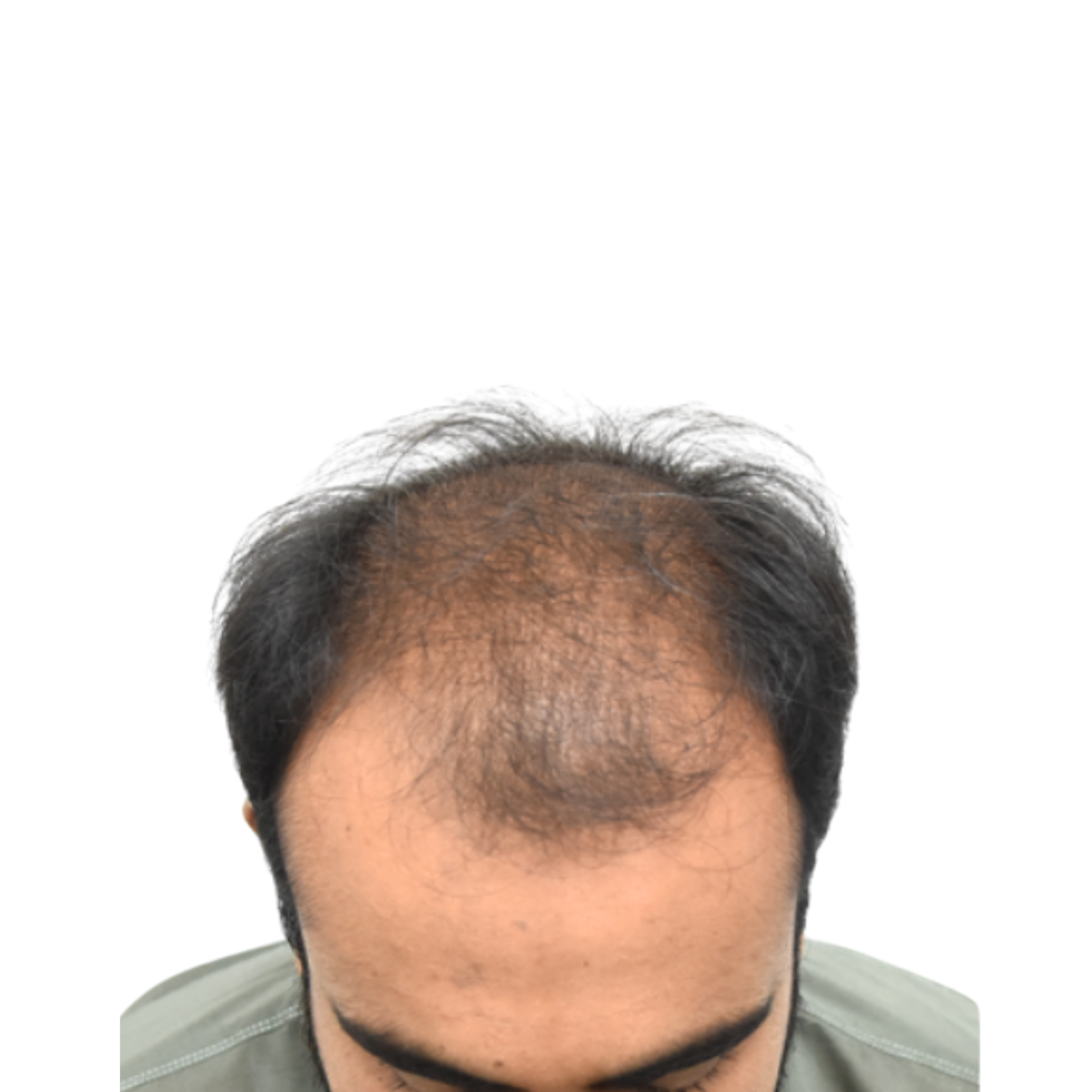 Nouman Before